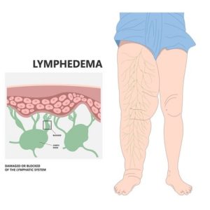 Liposuction Surgery For Lipedema Islamabad