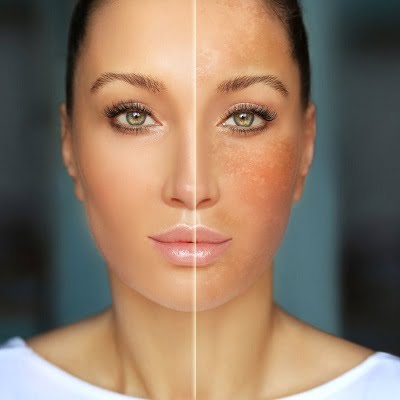 Melasma treatment in Islamabad