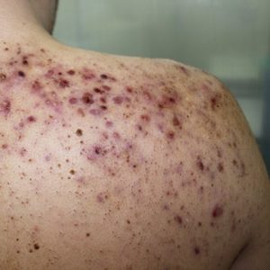 What is Acne Conglobata, and How is it Treated?