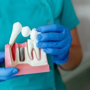 Which is better, implant or root canal?