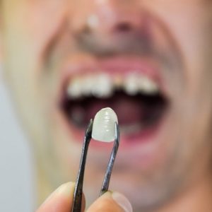 5 Dental Procedures for Cracked and Broken Tooth in Islamabad