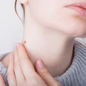 At What Age Can You Remove Birthmarks?