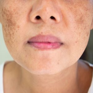 Best Treatments for Dark Spots on The Face