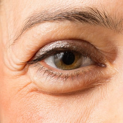 Can Eye Bags Return After Blepharoplasty in Islamabad