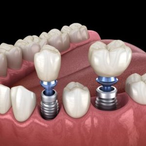 How To For Prepare a Dental Implant Surgery