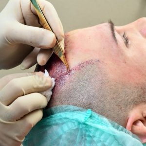 How Long Does It Take to Look Normal After a Hair Transplant?