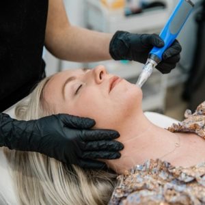 Microneedling of Acne Scars