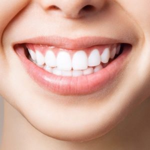 Teeth whitening cost in Pakistan