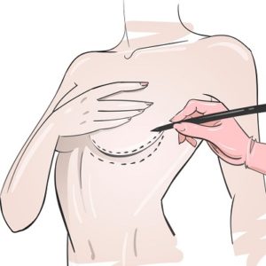Breast Filler Injection Cost in Islamabad