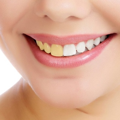 Different types of teeth whitening treatments in Islamabad