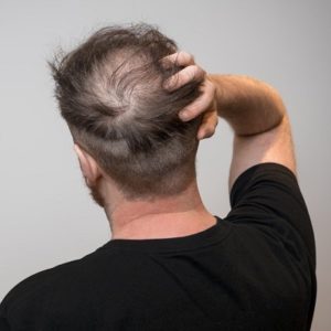 What Kind of Doctor Treats Balding in Islamabad