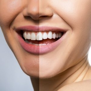 Is Full Body Skin Whitening Possible in Islamabad