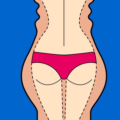 Liposuction Surgery for Buttocks in Islamabad, Pakistan