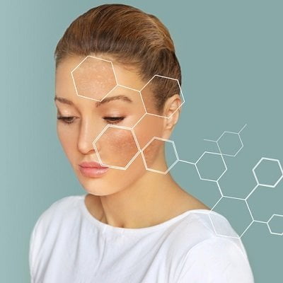 PRP Micro-Needling for Hyperpigmentation in Islamabad