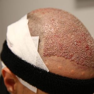Questions To Ask The Surgeon After A Hair Transplant