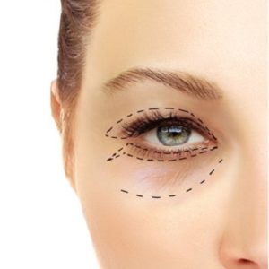 Upper Eyelid Blepharoplasty in Islamabad
