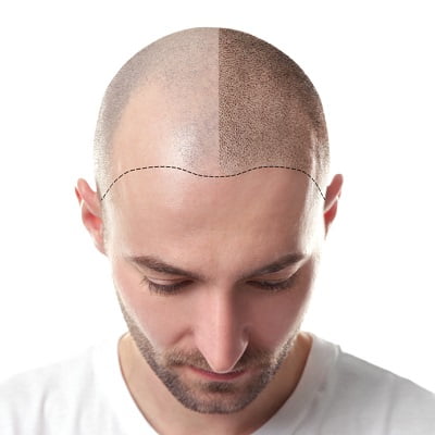 8 Factors That Affect the Cost of Your Hair Transplant