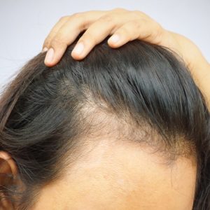 Baldness Treatment for Women in Islamabad