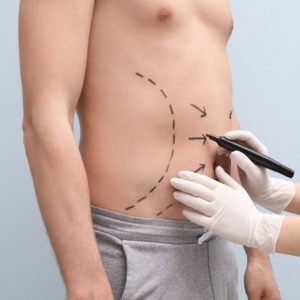 Best age for liposuction in Islamabad