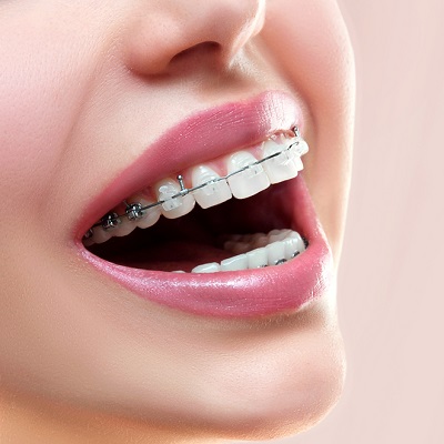 Types Of Orthodontic Braces In Islamabad