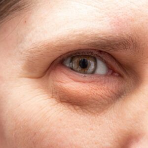 5 things you must know about eye bag removal