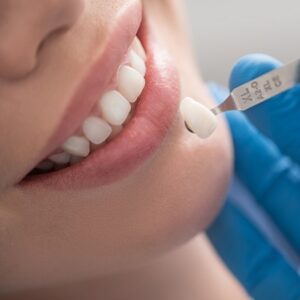 All About Dental Crowns by the Best Dentist in Islamabad