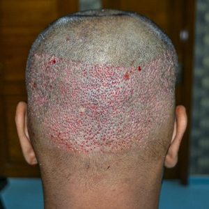 How many grafts survive after hair transplant?
