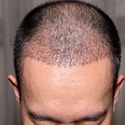 Is FUE hair transplant dangerous?