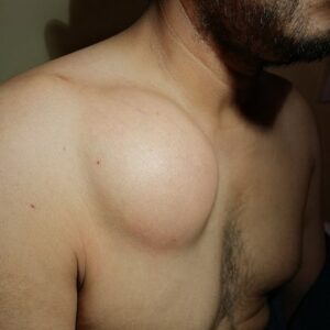 Lipoma treatment cost in Islamabad