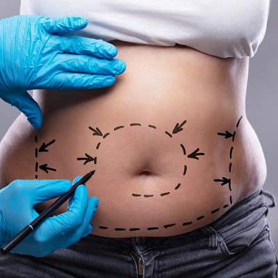 What is the average weight loss after liposuction