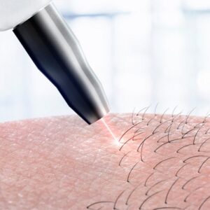 4 Misconceptions about Laser Hair Removal in Islamabad