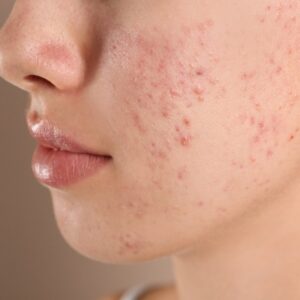 Acne Scars Treatment Guide: Regain Self-Assurance in Your Skin