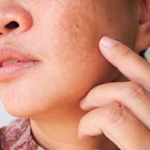 Best doctors for Melasma Treatment in Islamabad