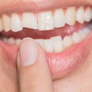 How long does a fractured tooth take to heal?