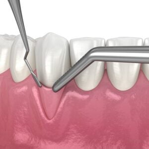 Is Gum Grafting worth it?