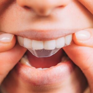 Whitening Strips: The Real Story