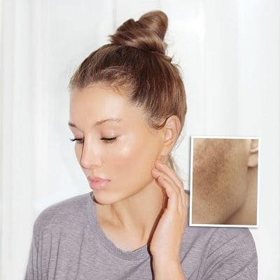 What our experts says about Melasma