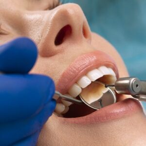 When You Have to Consider Dental Fillings for Your Cavities?