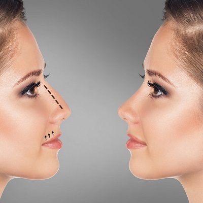 Everything you need to know about Nose Tip Plasty