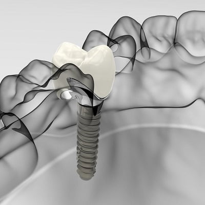How much successful are dental implants in Islamabad