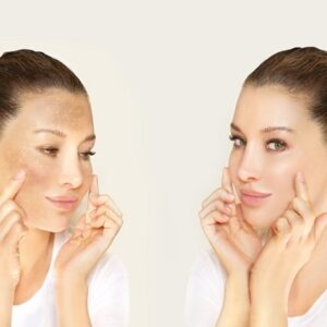 Is Skin Whitening Treatment A Scam?