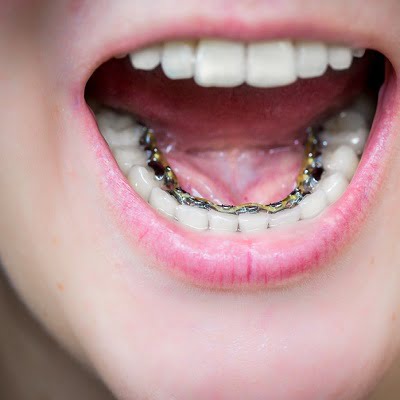 Common Misconceptions About Lingual Braces