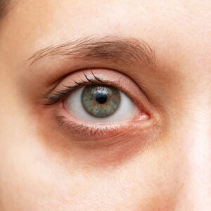 Treat Your Fine Lines and Dark Circles with Threads Islamabad