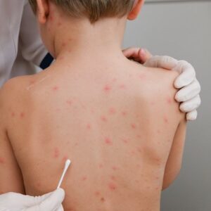 Chicken Pox Scar Removal in Islamabad