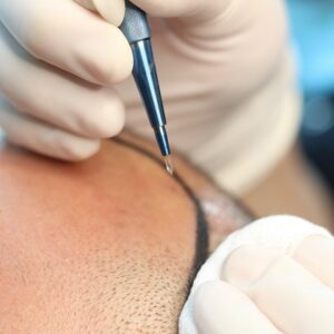 Get a Hair Transplant in Winter