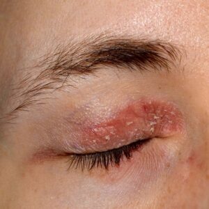 How To Treat Eczema On Your Eyelids?