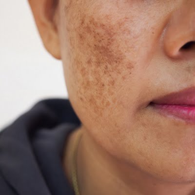 Mild Melasma Treatment in Islamabad.