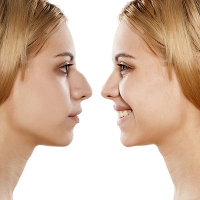 Non-surgical Nose job for narrowing a wide nose in Islamabad