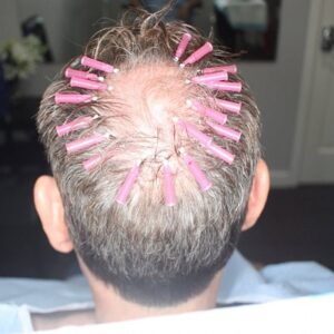 PDO Scalp Threading – Grow your hair faster