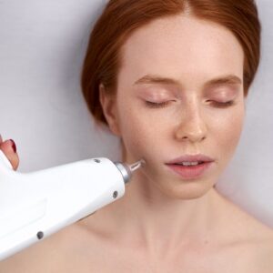 RF microneedling benefits of Scarlet